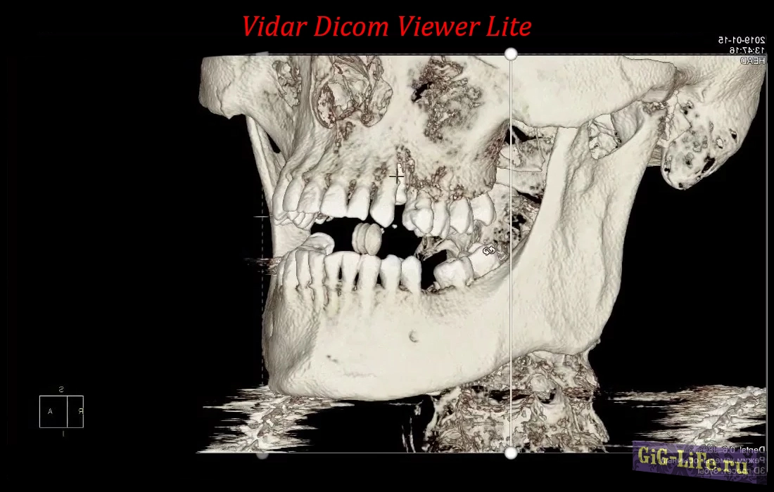 Vidar Dicom Viewer Lite